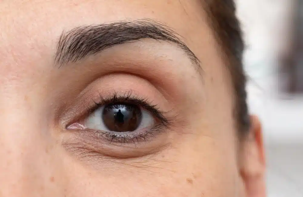 ฟิลเลอร์ใต้ตาอยู่ได้กี่เดือน