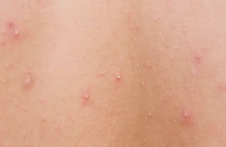 สิวหัวขาว