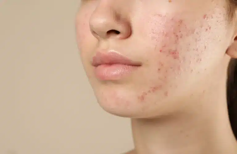 สิวติดสาร