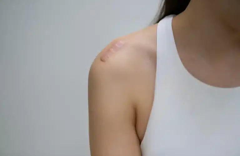 คีลอยด์ (Keloid) เกิดจากอะไร