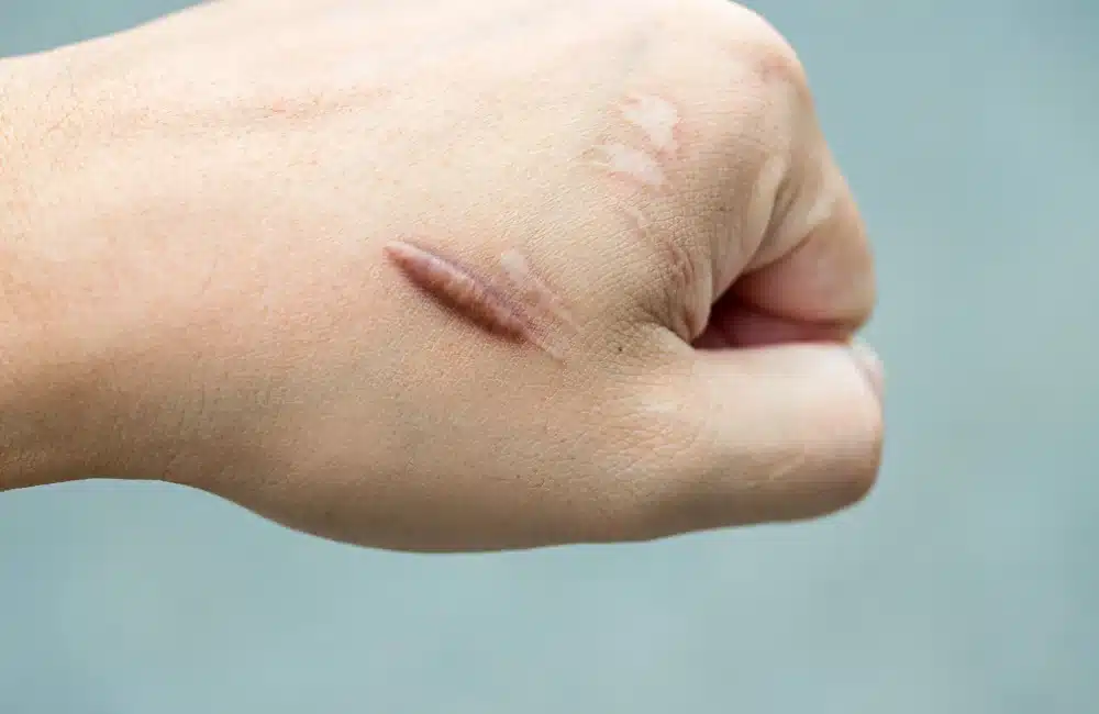 คีลอยด์ (Keloid) เกิดจากอะไร