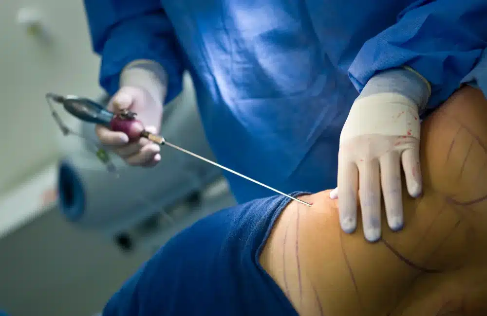 ดูดไขมัน กับ ฉีดสลายไขมัน อันไหนดีกว่ากัน