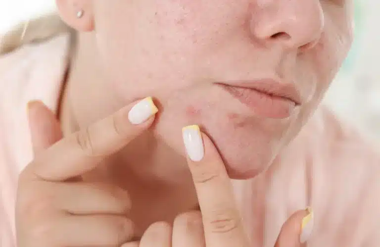 สิวฮอร์โมนรักษายังไง