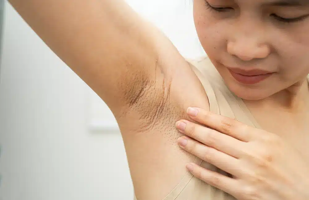 รักแร้ดำ เกิดจาก