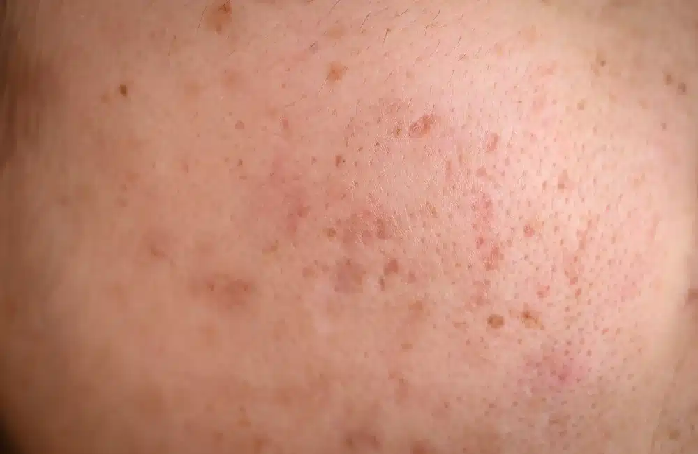 ฝ้าตื้น