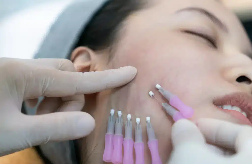 ร้อยไหม คือ