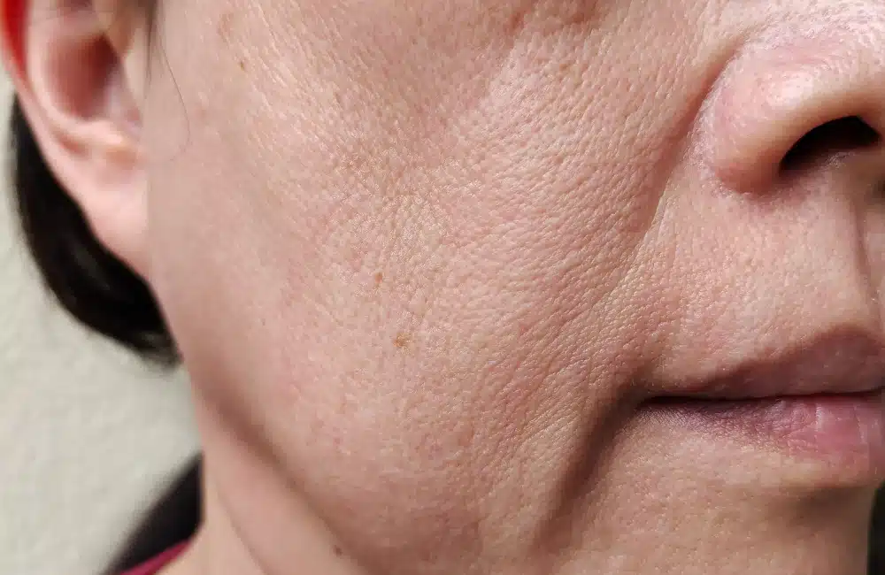 ผิวหย่อนคล้อย เกิดจากอะไร? รวมวิธีแก้ยกกระชับ หน้าเด็กทันที