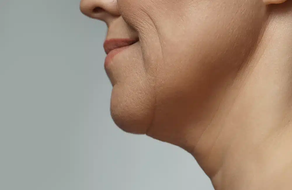 ผิวหย่อนคล้อ