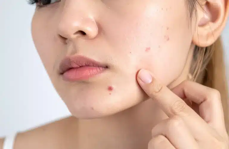 รักษาสิว