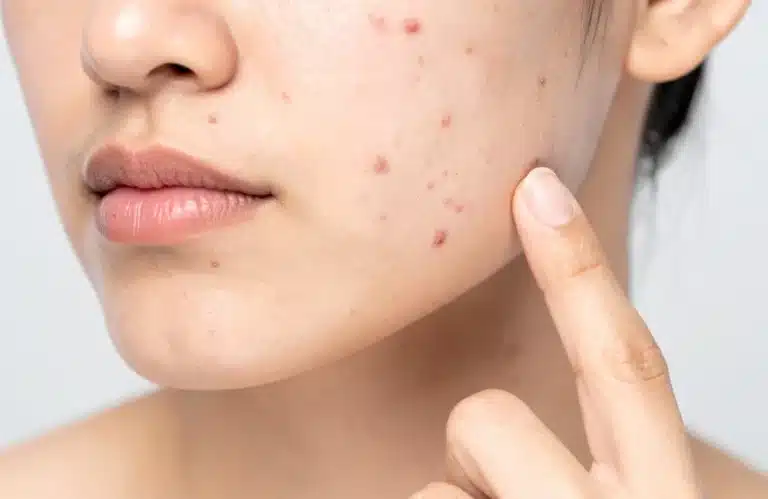 สิวไม่มีหัวนูน ๆ เกิดจากอะไร