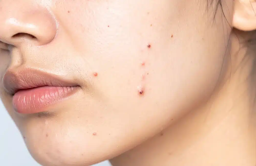 สิวไม่มีหัวนูน ๆ เกิดจากอะไร