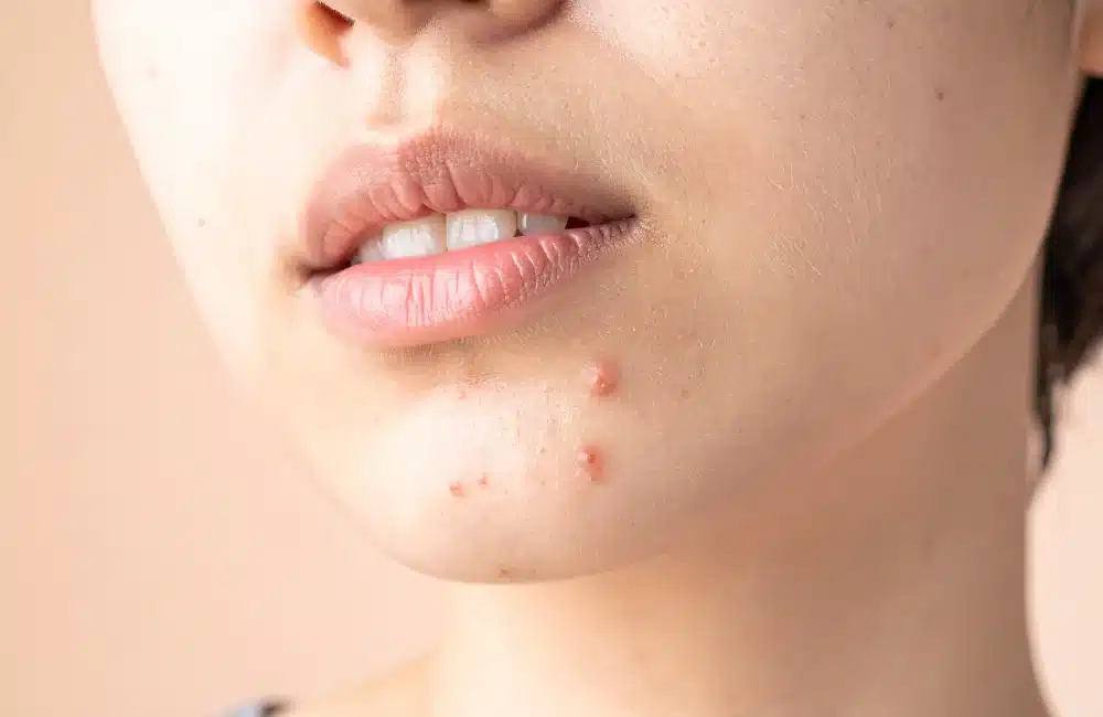 รักษาสิว