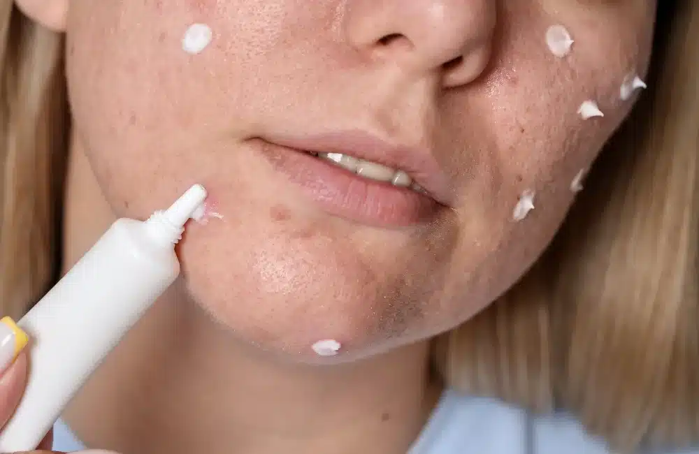 สิวไม่มีหัวนูน ๆ รักษายังไงให้ยุบไว