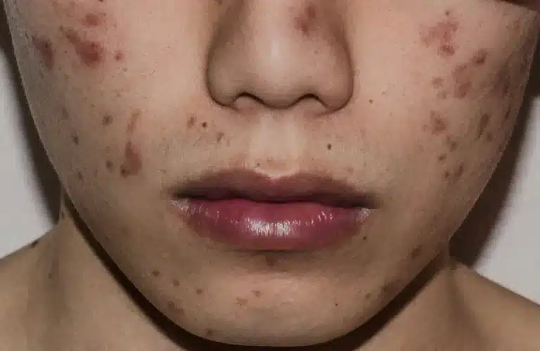 สิวเห่อเกิดจากอะไร