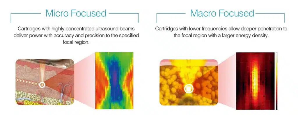 MMFU (Micro & Macro Focused Ultrasound) คืออะไร

