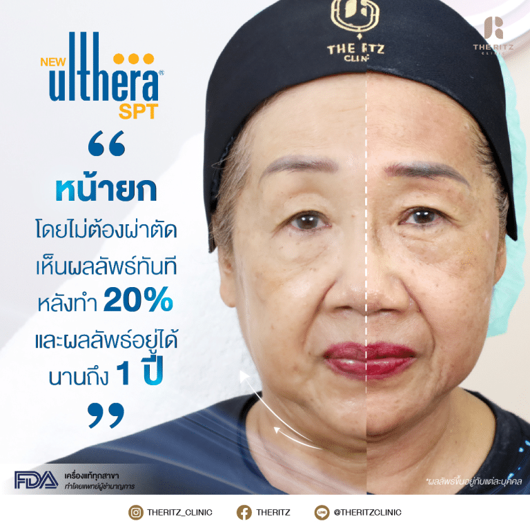 รีวิวยกกระชับผิวหน้าด้วย Ulthera SPT รีวิวก่อนทำและหลังทำทันที