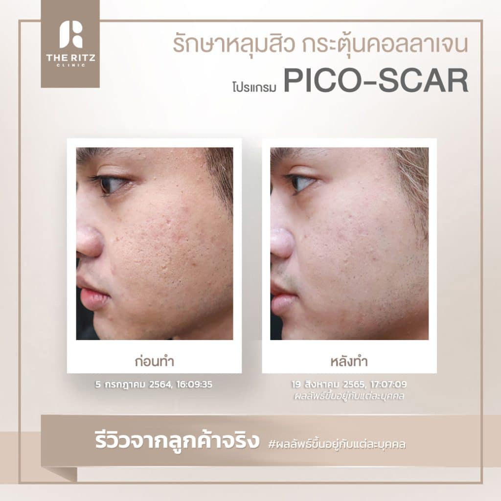 รีวิวรักษาหลุมสิวด้วย Pico Laser ก่อนทำและหลังทำ