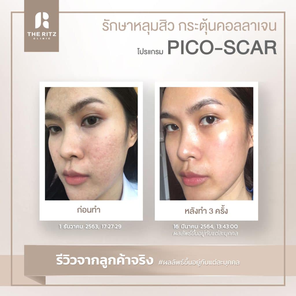 รีวิว โปรแกรม PICO-Scar รักษาหลุมสิว รอยสิว รอยดำ ก่อนทำและหลังทำ 3 ครั้ง