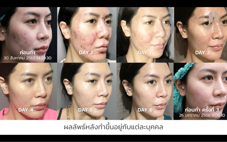 รีวิว Pico Laser รักษาหลุมสิว โดยคุณแตงโม