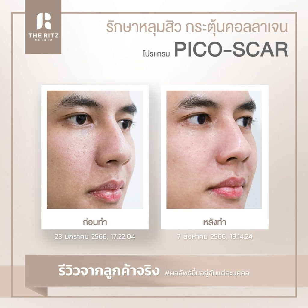 รีวิวรักษาหลุมสิวด้วย Pico Laser ก่อนทำและหลังทำ