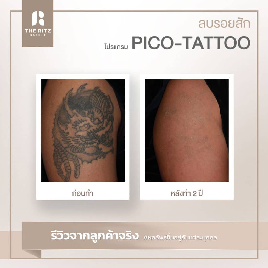 รีวิว โปรแกรม PICO-Tattoo ลบรอยสัก ก่อนทำและหลังทำ 2 ปี