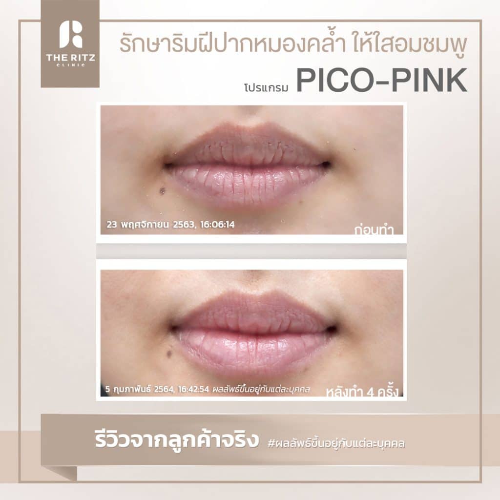 รีวิว โปรแกรม PICO-Pinkรักษาริมฝีปากหมองคล้ำให้ใสอมชมพู ก่อนทำและหลังทำ 2 ครั้ง