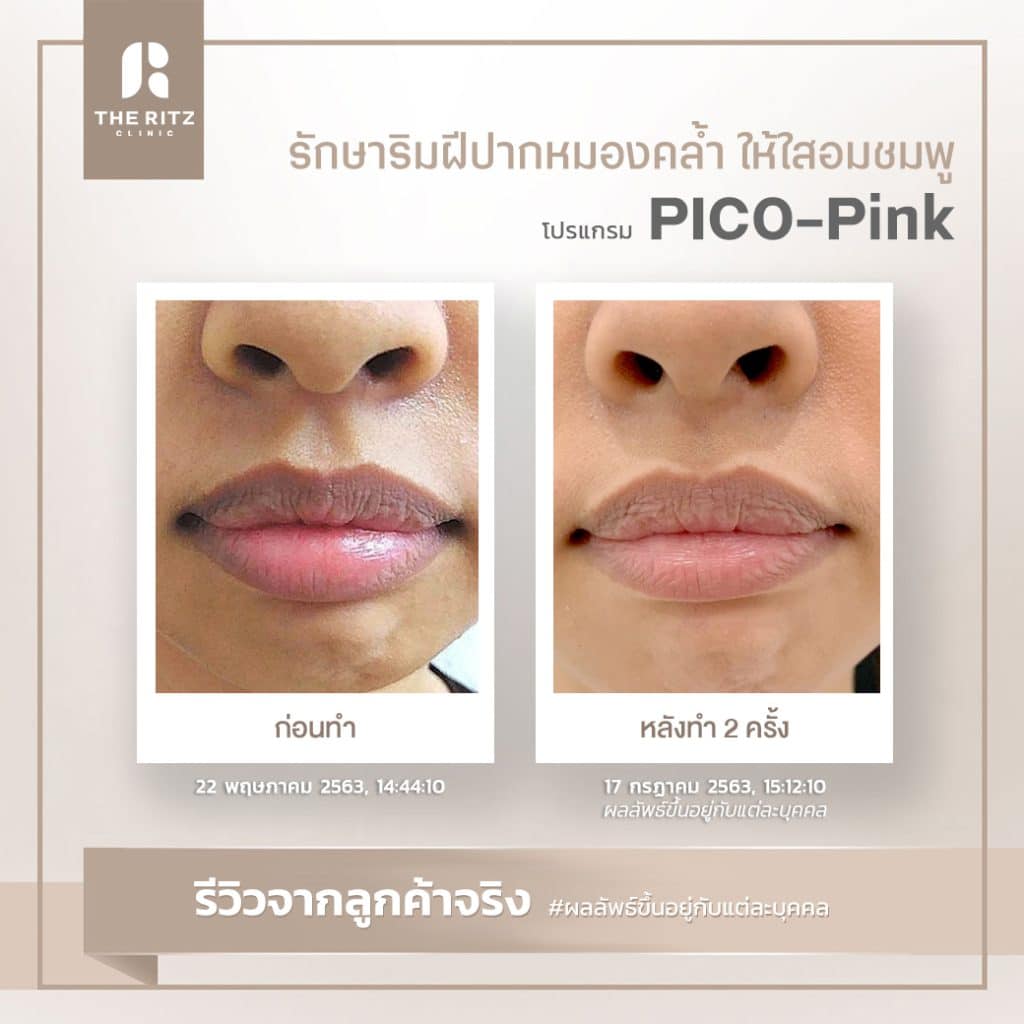 รีวิว โปรแกรม PICO-Pink รักษาริมฝีปากหมองคล้ำให้ใสอมชมพู ก่อนทำและหลังทำ 4 ครั้ง