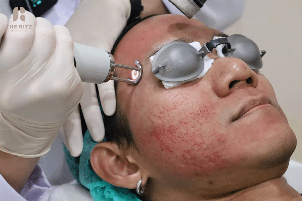 สนใจทำ Pico Laser ที่ THE RITZ CLINIC ทำอย่างไรดี