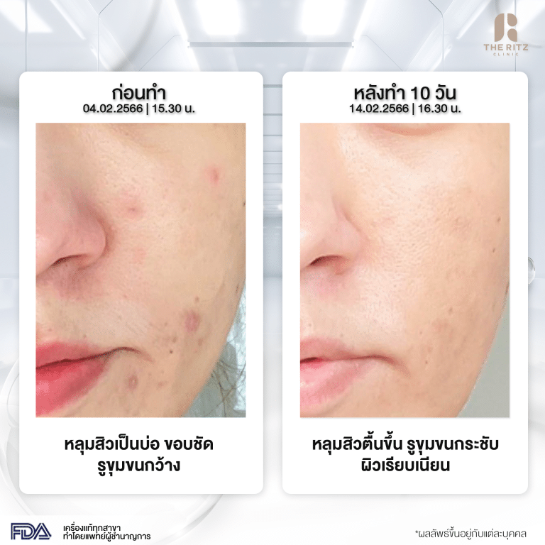 รีวิว Pico Laser ก่อนทำและหลังทำ 10 วัน โดยคุณเม
