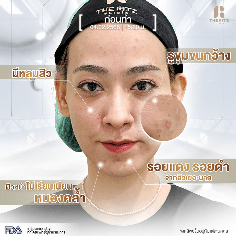 รีวิว Pico Laser ภาพก่อนทำ โดยคุณเม