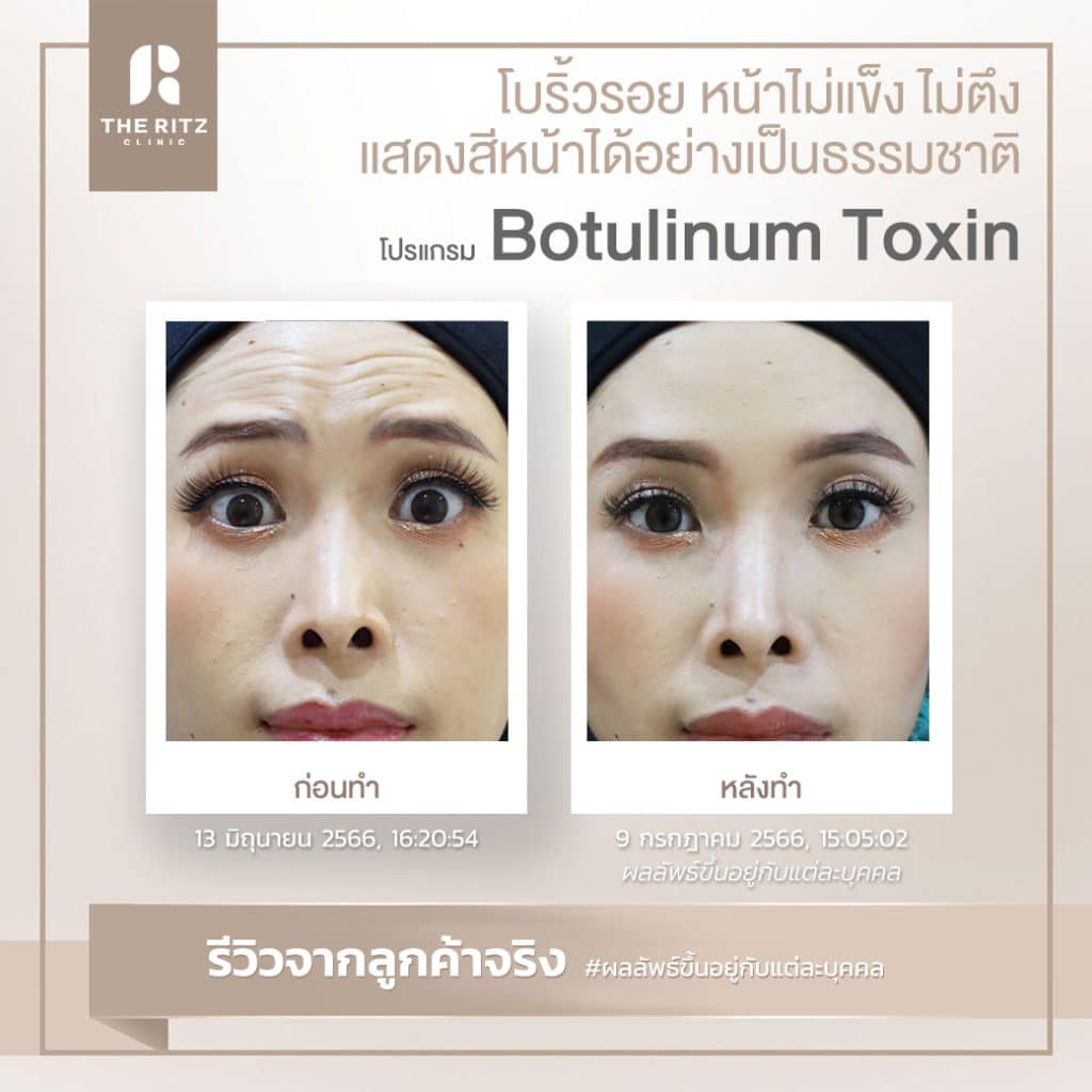 รีวิวฉีดโบท็อกซ์ริ้วรอยก่อนทำและหลังทำ