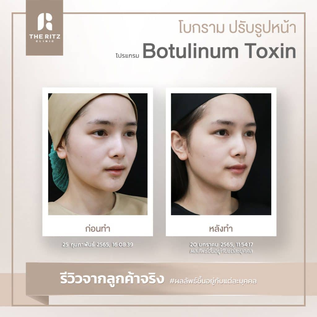 รีวิวฉีดโบท็อกซ์กรามก่อนทำและหลังทำ