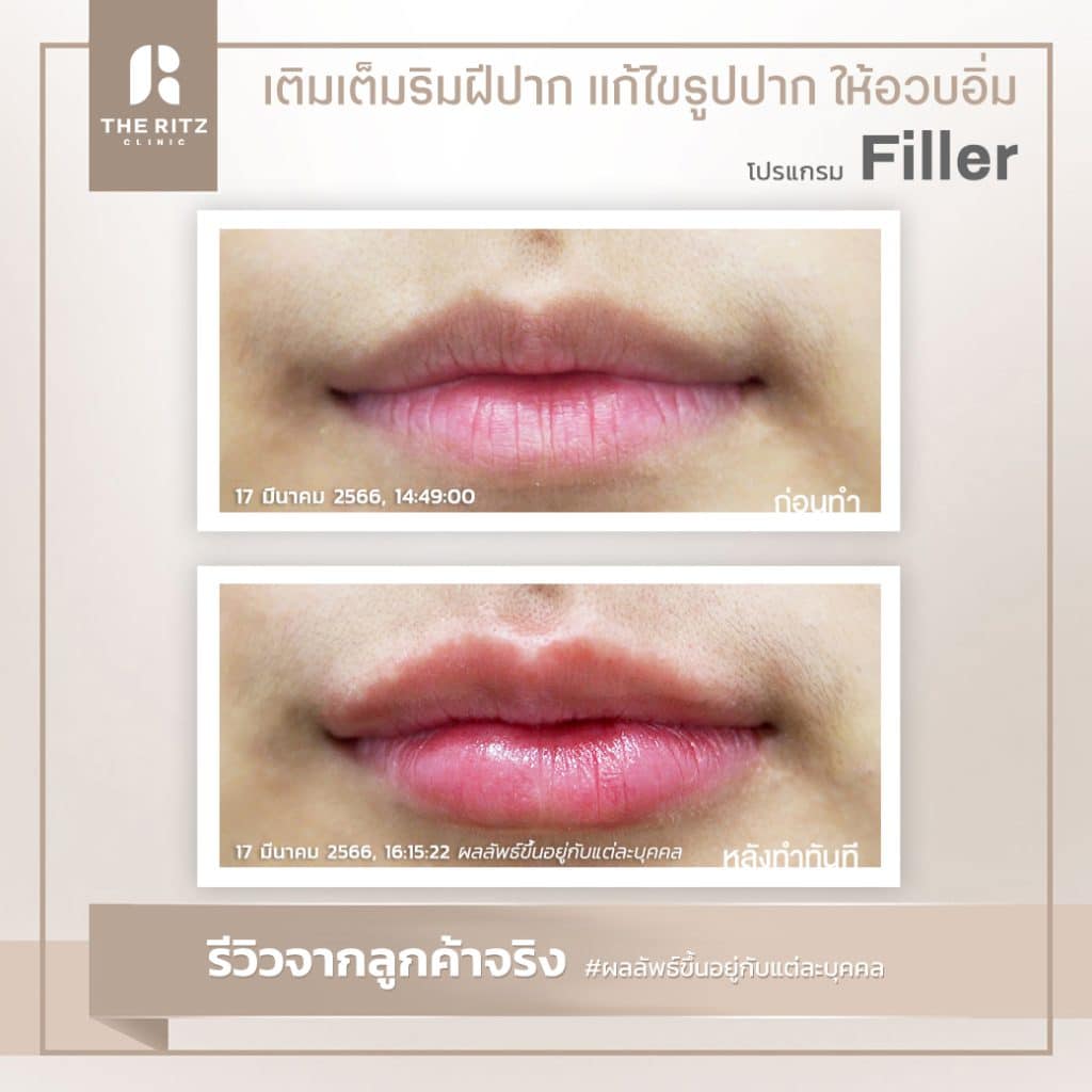 รีวิวฉีดฟิลเลอร์ปาก ปรับโครงสร้างริมฝีปากให้เท่ากัน และเพิ่มเนื้อปาก