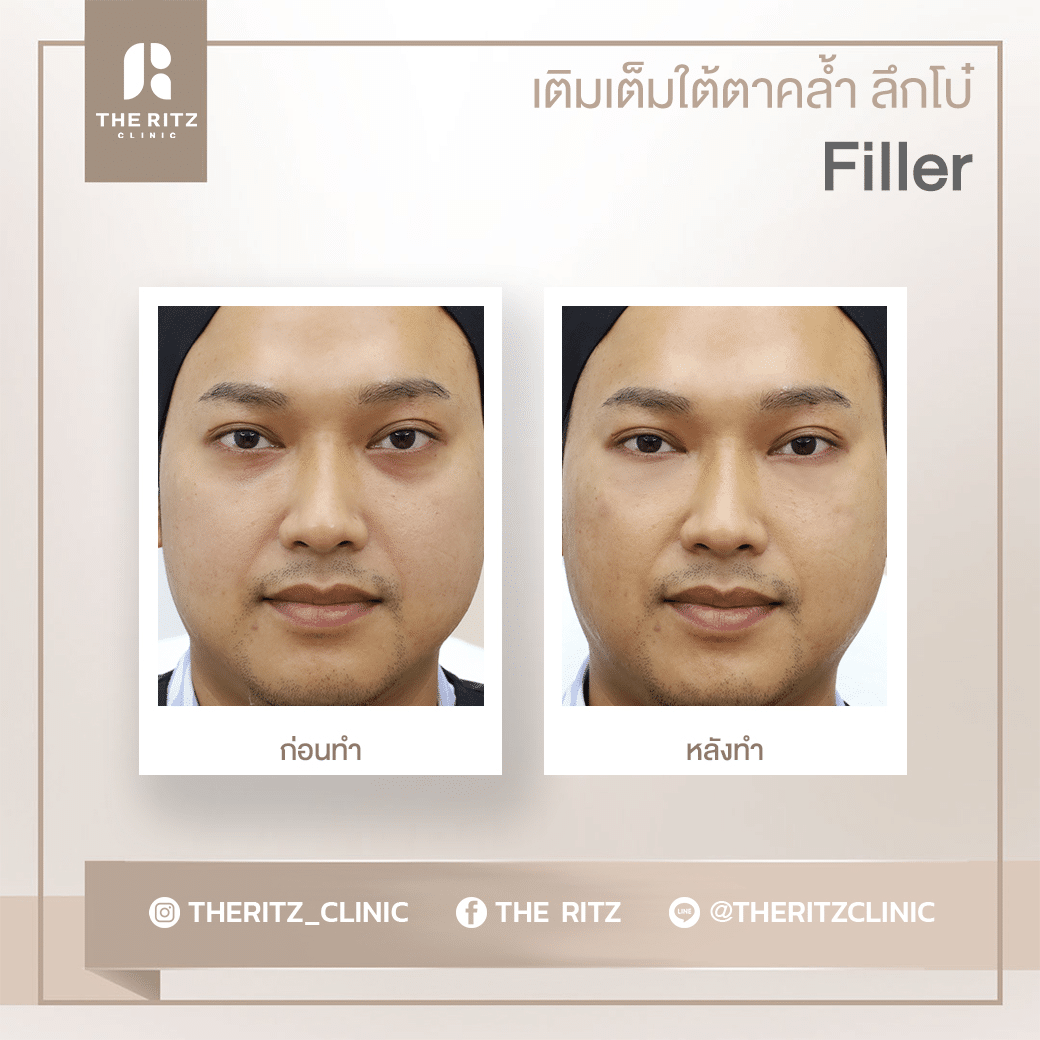 รีวิวฟิลเลอร์ใต้ตา เติมเต็มใต้ตาคล้ำ ลึกโบ๋ ก่อนทำและหลังทำ