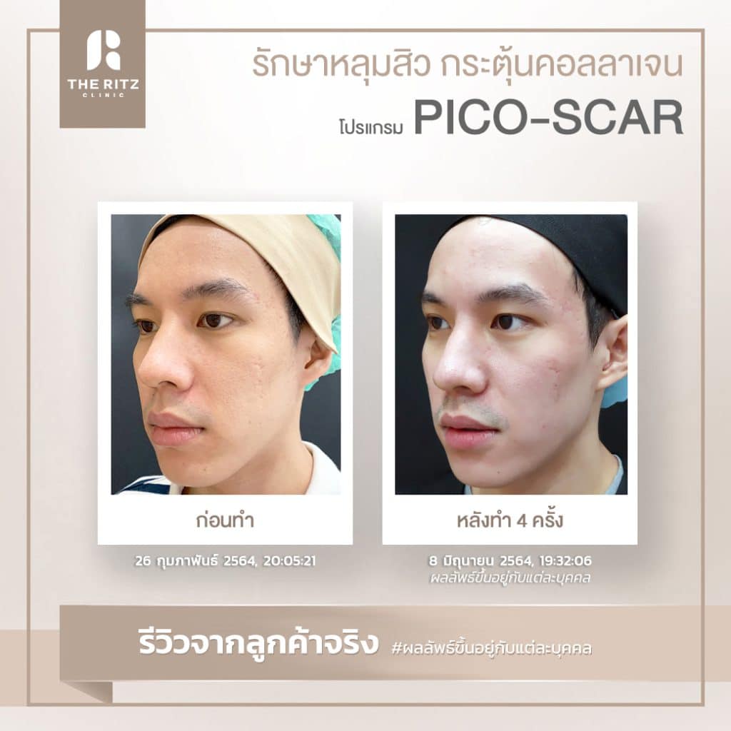 รีวิว โปรแกรม PICO-Smooth ผิวเรียบเนียน ลดรอยดำ รอยแดง ก่อนทำและหลังทำ 4 ครั้ง