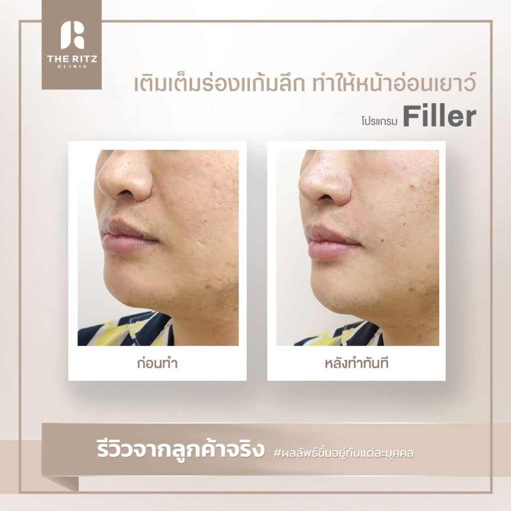 รีวิวฟิลเลอร์ร่องแก้ม เติมเต็มร่องแก้มและร่องน้ำหมาก ก่อนทำและหลังทำ