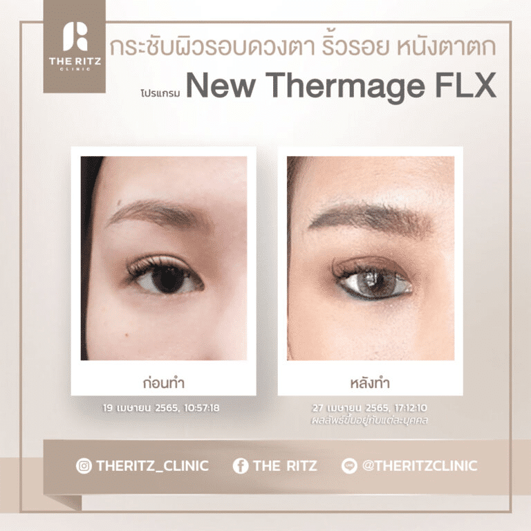 รีวิวทำ New Thermage FLX ก่อนทำ และ หลังทำ