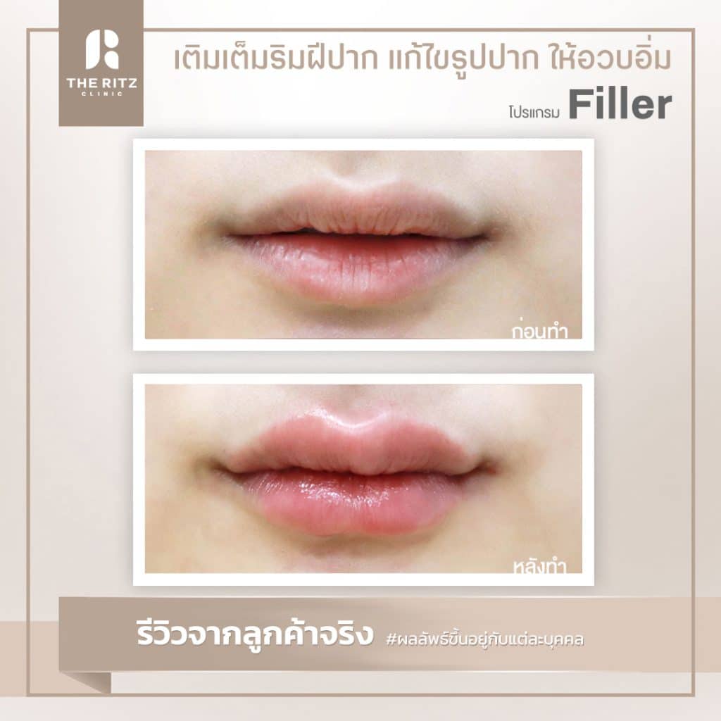 รีวิวฉีดฟิลเลอร์ปาก ปรับโครงสร้างริมฝีปากให้เท่ากัน และเพิ่มเนื้อปาก