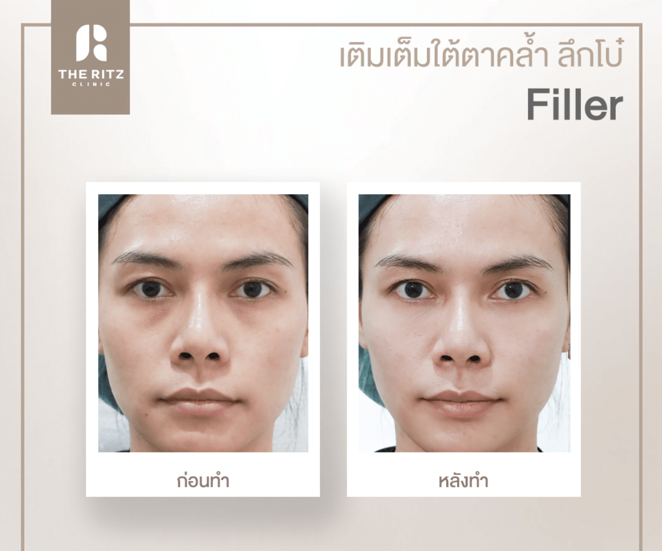 รีวิวฟิลเลอร์ใต้ตา เติมเต็มใต้ตาคล้ำ ลึกโบ๋ ก่อนทำและหลังทำ