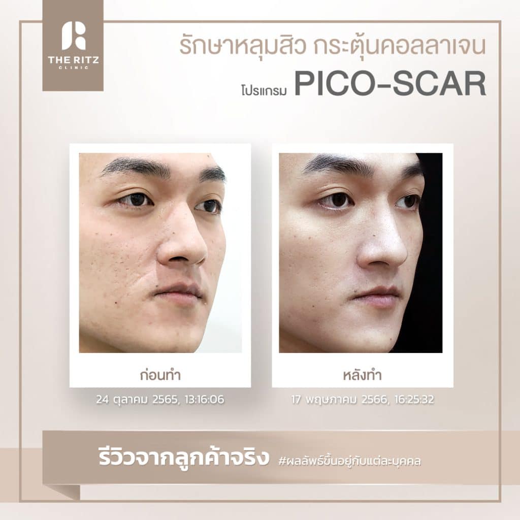 รีวิวรักษาหลุมสิวด้วย Pico Laser ก่อนทำและหลังทำ