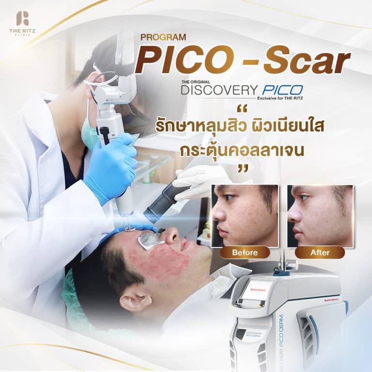รวมรีวิว Pico Laser รักษาหลุมสิว รอยสิว รอยดำ ที่ THE RITZ CLINIC