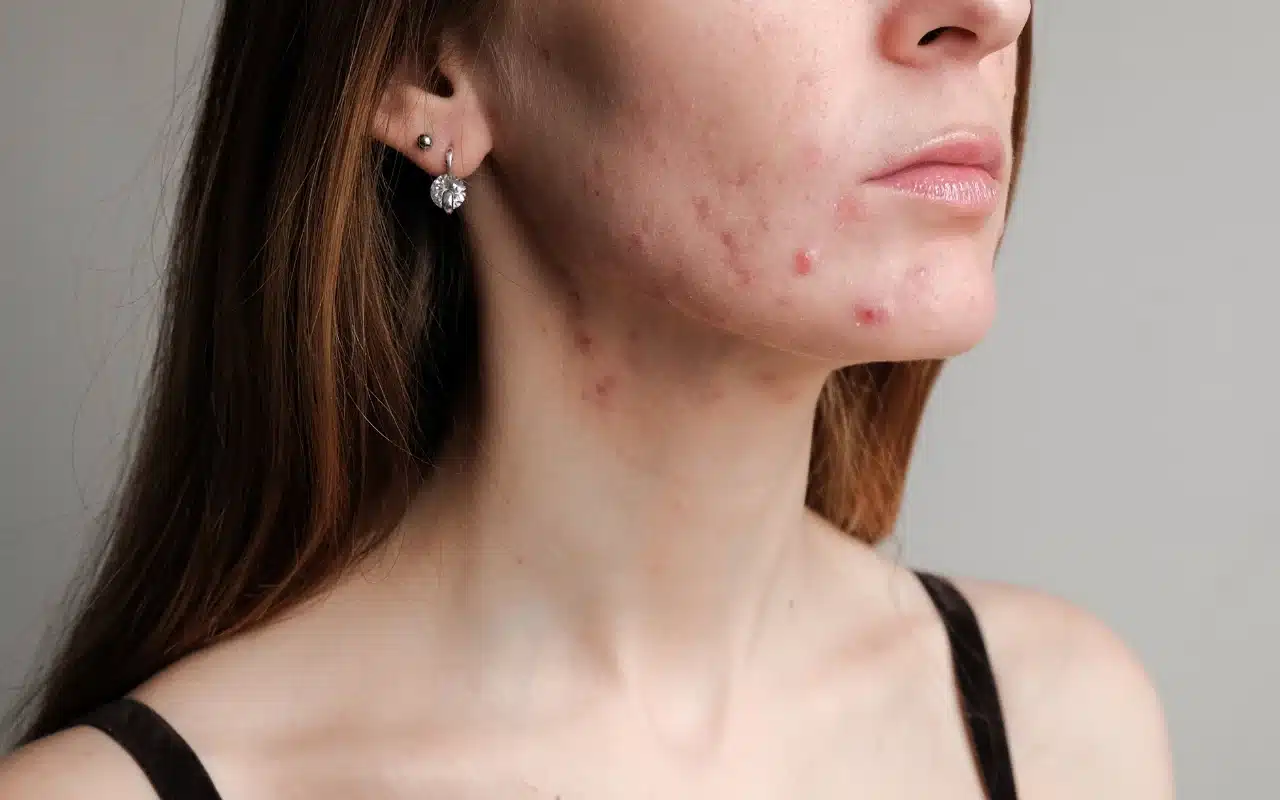 หน้าเป็นหลุมสิวหายเองได้ไหม