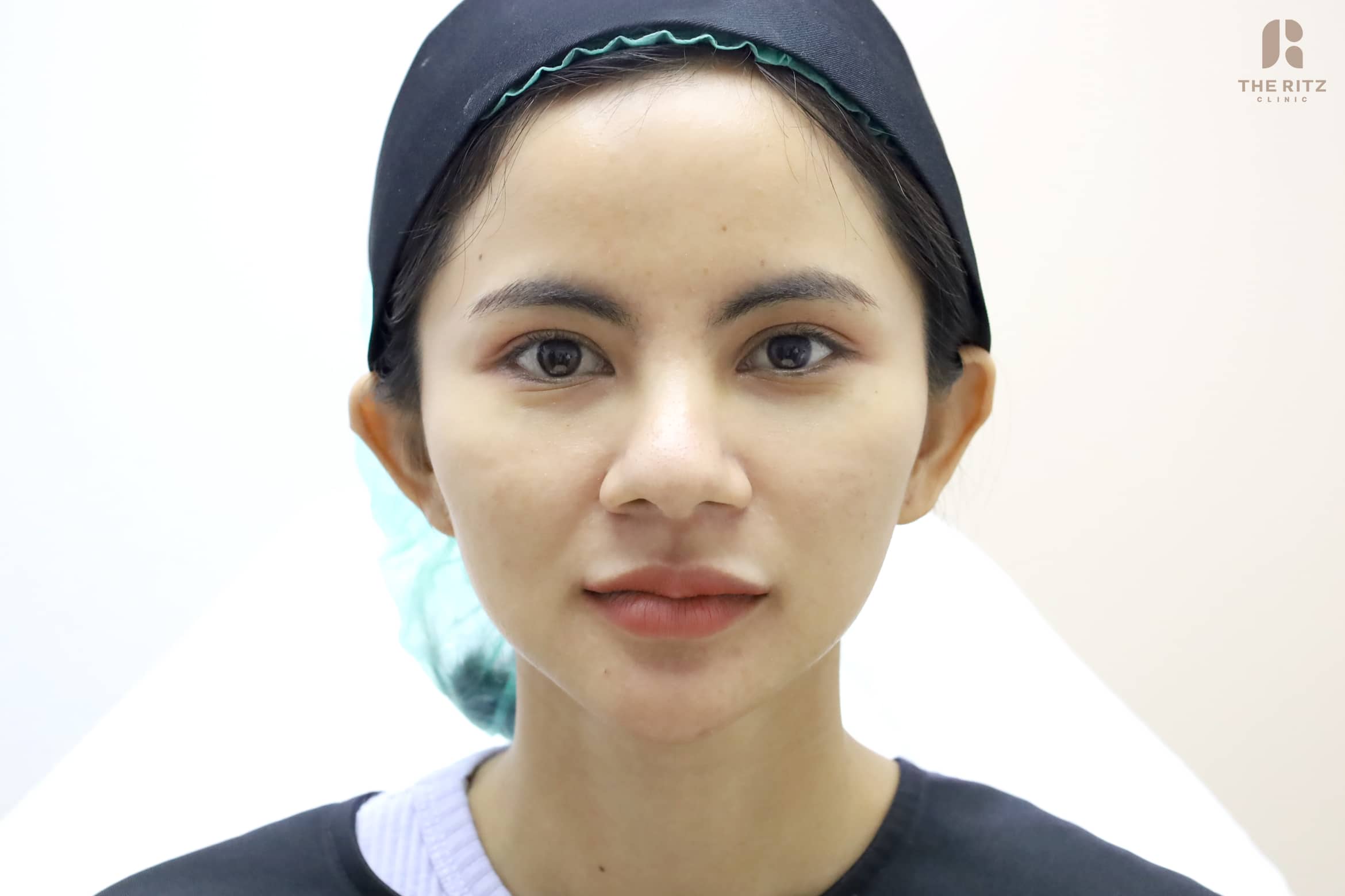 แก้มตอบเกิดจากอะไร แก้ยังไงให้หน้าดูอิ่มธรรมชาติ