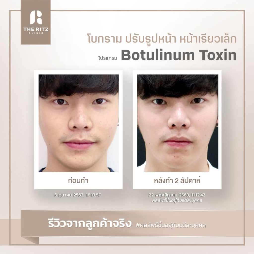 BOTOX