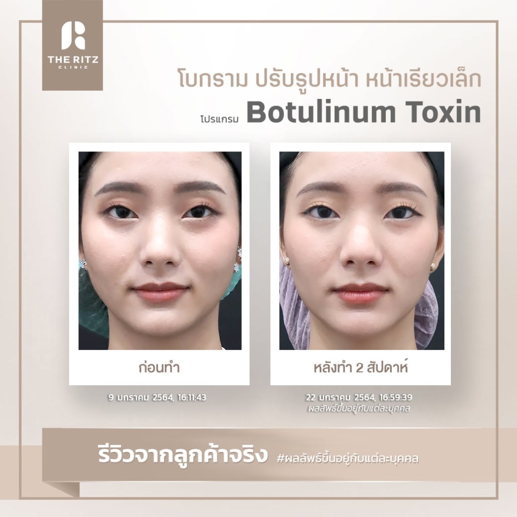 BOTOX