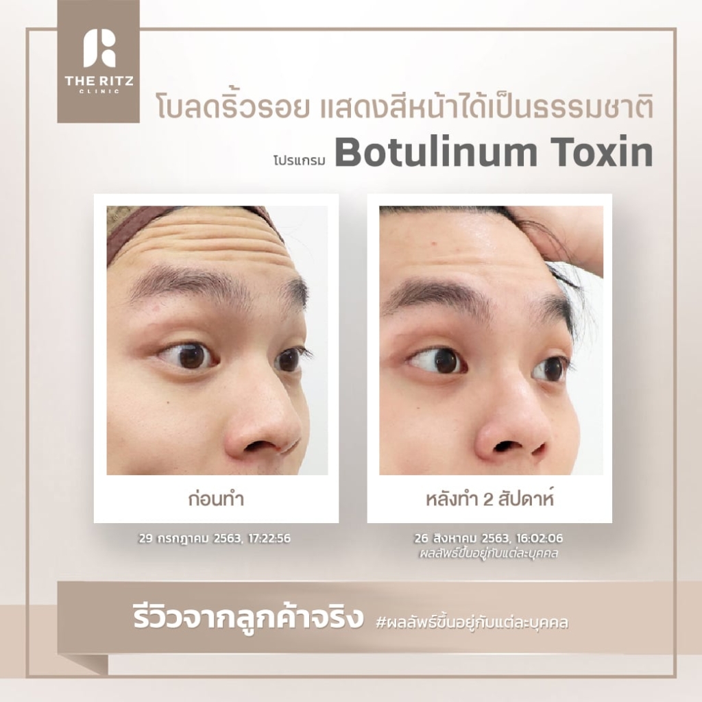 BOTOX