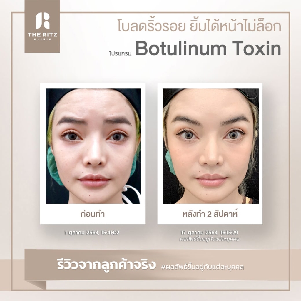 BOTOX