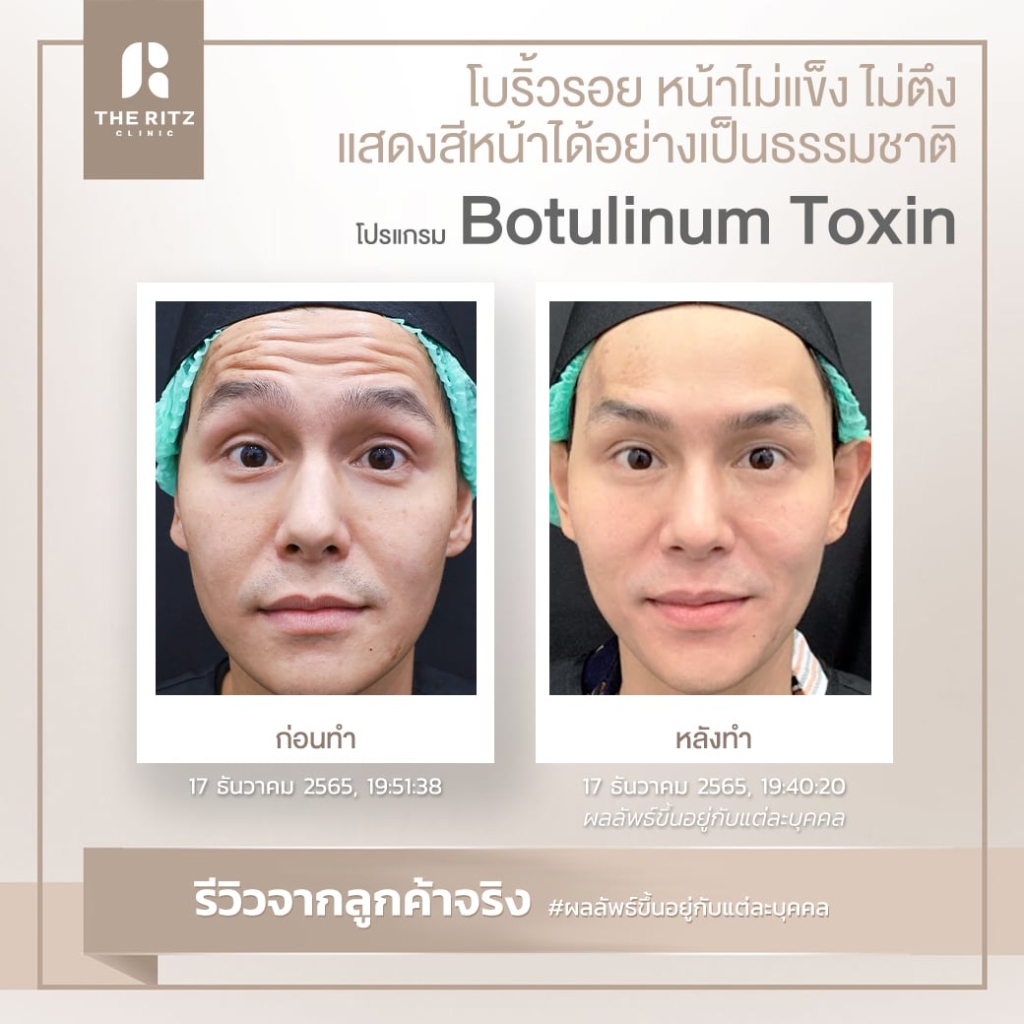 BOTOX