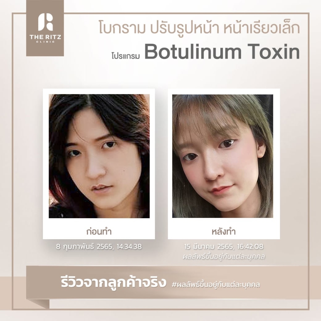 BOTOX