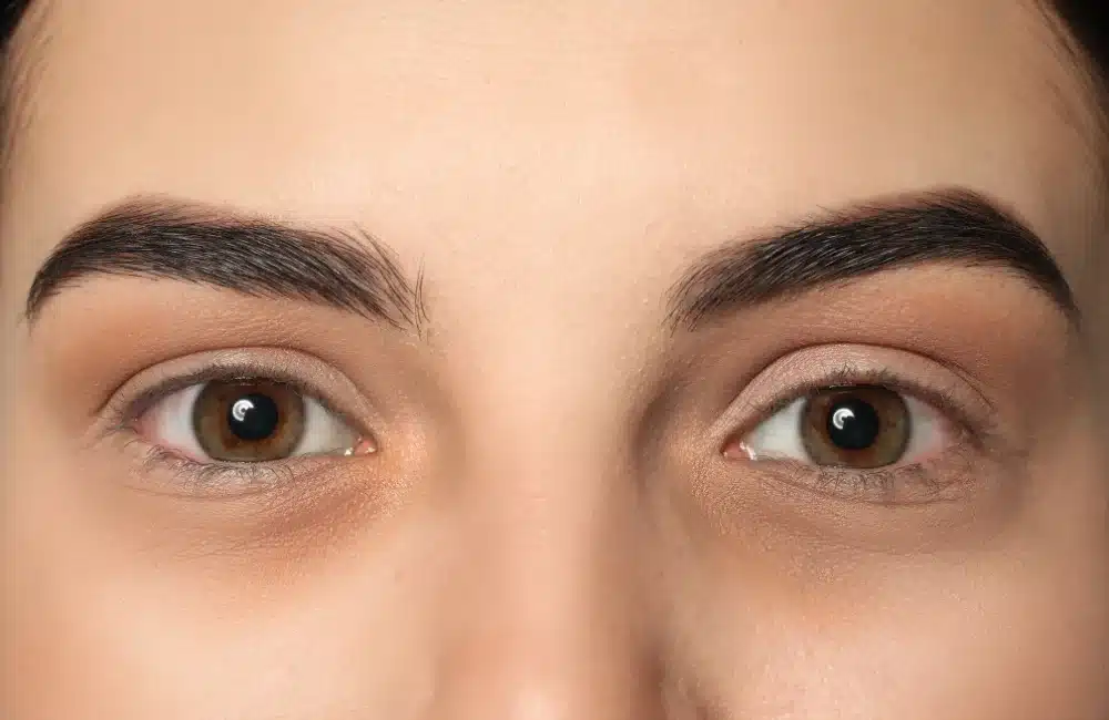 ฉีดโบท็อกถุงใต้ตาช่วยได้จริง มีข้อควรระวังอะไรบ้าง